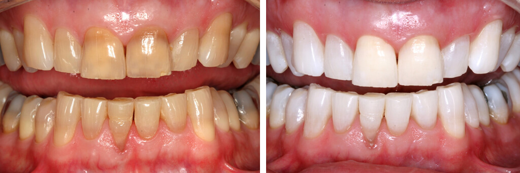 Teeth whitening example 1