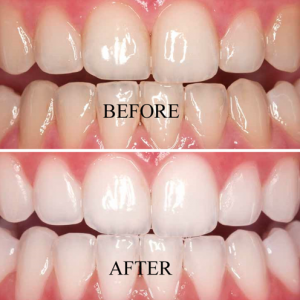 Teeth whitening example 2